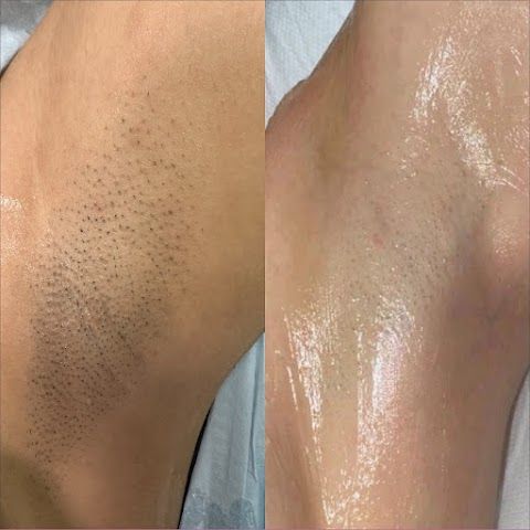 Beauty Laser Studio - laser hair removal Worcester — sew-in stylist in Worcester, Massachusetts